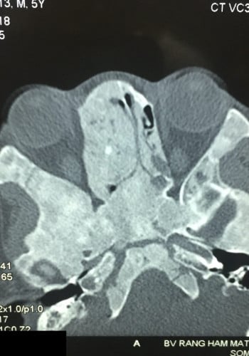After Image: Craniofacial Tumor - front