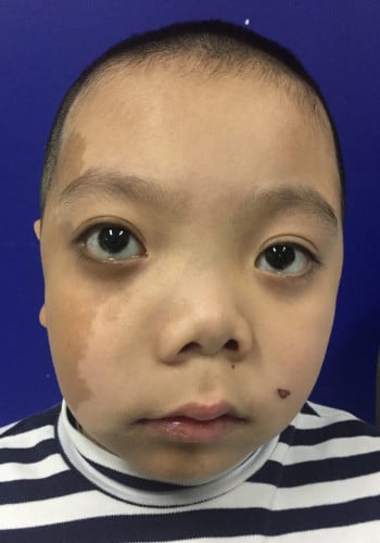Before Image: Craniofacial Tumor - front