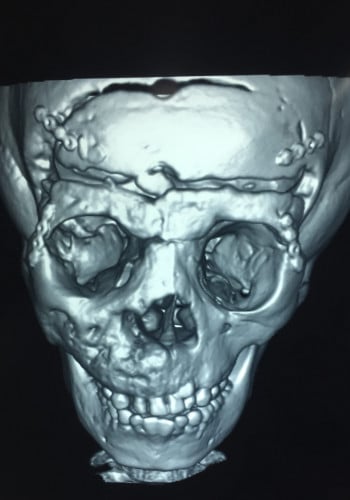 After Image: Craniofacial Tumor - front