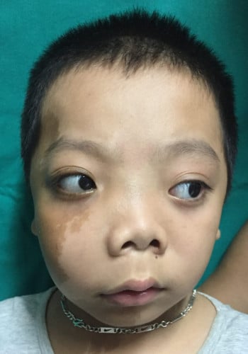 Before Image: Craniofacial Tumor - front