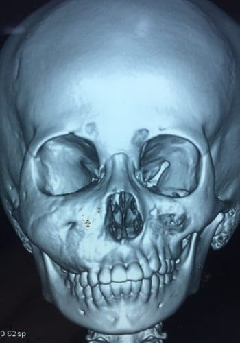 After Image: Craniofacial Tumor - front