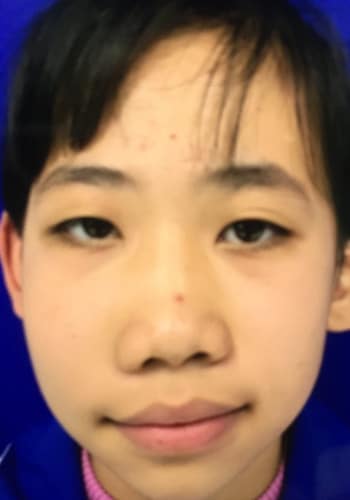 Before Image: Craniofacial Tumor - front