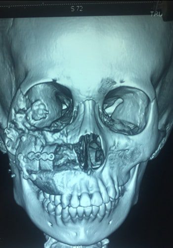After Image: Craniofacial Tumor - front