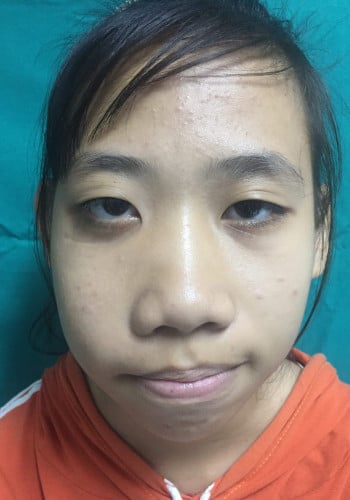 Before Image: Craniofacial Tumor - front