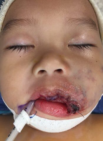 After Image: Venous Malformation - front