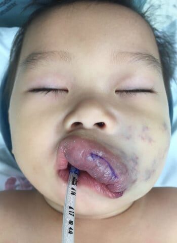 Before Image: Venous Malformation - front