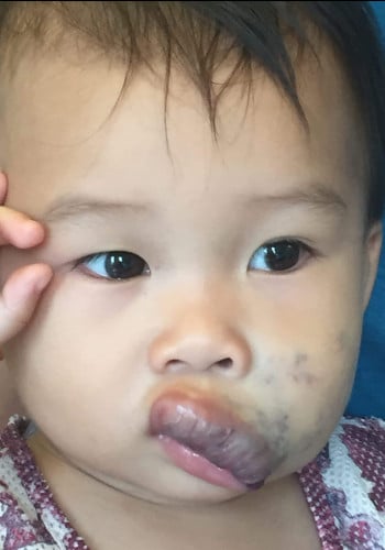 After Image: Venous Malformation - right-front-oblique