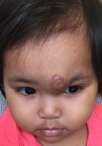 Before Image: Venous Malformation - front