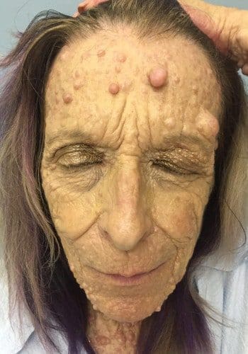 Before Image: Neurofibromatosis Case Study 10 – Reconstruction Example - front