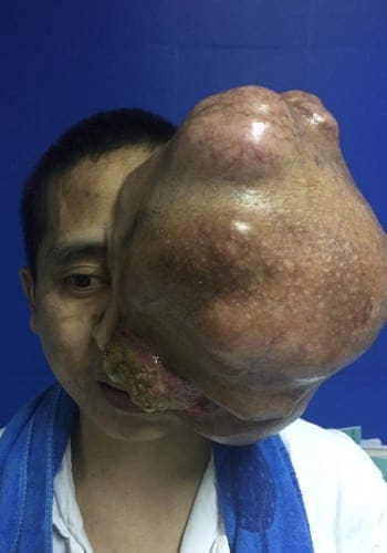 Before Image: Craniofacial Tumors - front