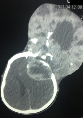Before Image: Craniofacial Tumors - front