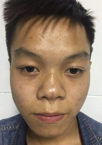 After Image: Facial Cleft - front