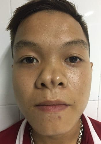 Before Image: Facial Cleft - front