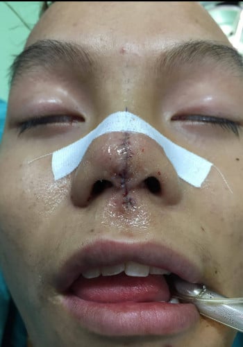 After Image: Facial Cleft - other
