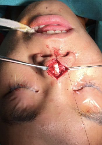 Before Image: Facial Cleft - other