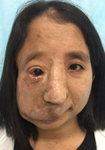 After Image: Neurofibromatosis Case Study 9 – Outcome Review - front