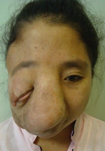 Before Image: Neurofibromatosis Case Study 9 – Outcome Review - front