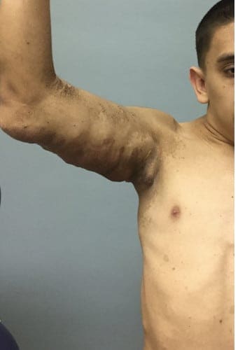 After Image: Neurofibromatosis Case Study 8 – Tumor Correction - front