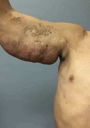 Before Image: Neurofibromatosis Case Study 8 – Tumor Correction - front