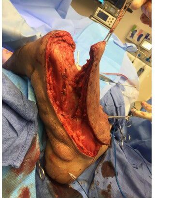 After Image: Neurofibromatosis Case Study 8 – Tumor Correction - right-side