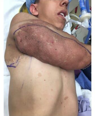 Before Image: Neurofibromatosis Case Study 8 – Tumor Correction - right-side