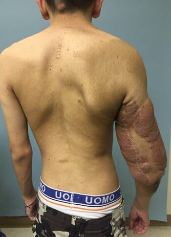 After Image: Neurofibromatosis Case Study 8 – Tumor Correction - back