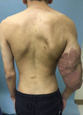 Before Image: Neurofibromatosis Case Study 8 – Tumor Correction - back