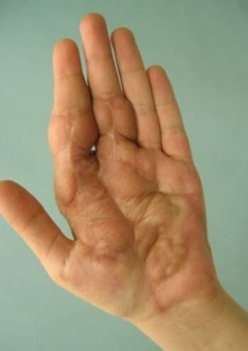 After Image: Neurofibromatosis Case Study 7 – Lesion Removal - front
