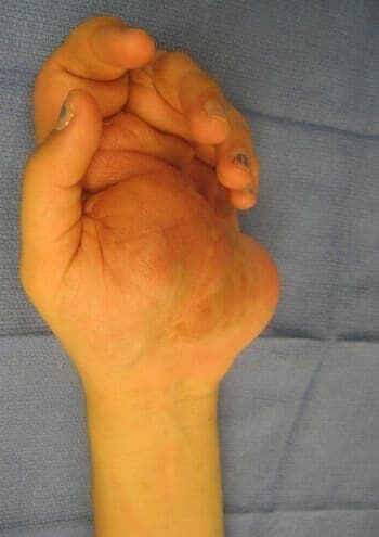 Before Image: Neurofibromatosis Case Study 7 – Lesion Removal - front