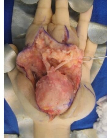 After Image: Neurofibromatosis Case Study 7 – Lesion Removal - front