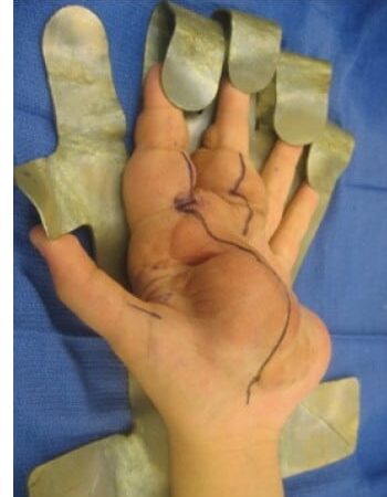 Before Image: Neurofibromatosis Case Study 7 – Lesion Removal - front