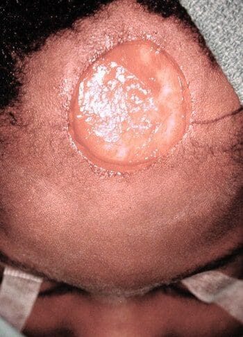 After Image: Craniofacial Tumor - front
