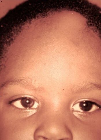 Before Image: Craniofacial Tumor - front