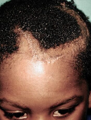 After Image: Craniofacial Tumor - front
