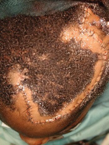 Before Image: Craniofacial Tumor - front