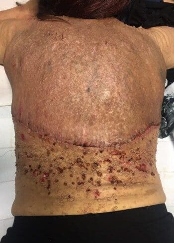 After Image: Neurofibromatosis Case Study 6 – Patient Journey - back