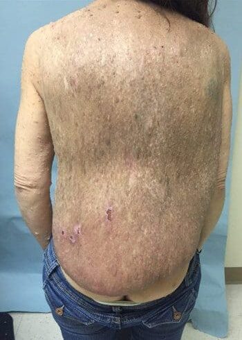 Before Image: Neurofibromatosis Case Study 6 – Patient Journey - back