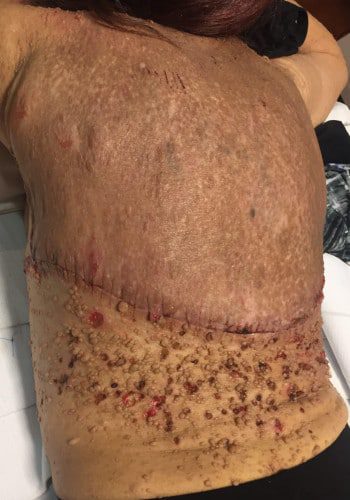 After Image: Neurofibromatosis Case Study 6 – Patient Journey - left-side