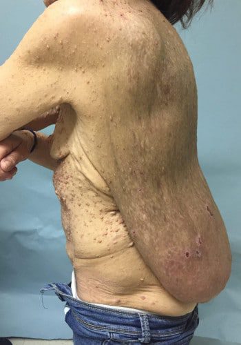 Before Image: Neurofibromatosis Case Study 6 – Patient Journey - left-side