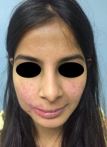 After Image: Facial Reconstruction - front