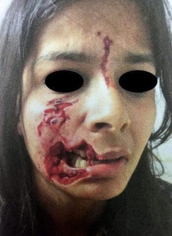 Before Image: Facial Reconstruction - front