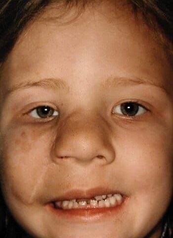 After Image: Neurofibromatosis Case Study 5 – Facial Reconstruction - front