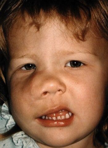 Before Image: Neurofibromatosis Case Study 5 – Facial Reconstruction - front