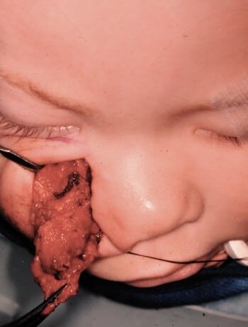 Before Image: Neurofibromatosis Case Study 5 – Facial Reconstruction - front