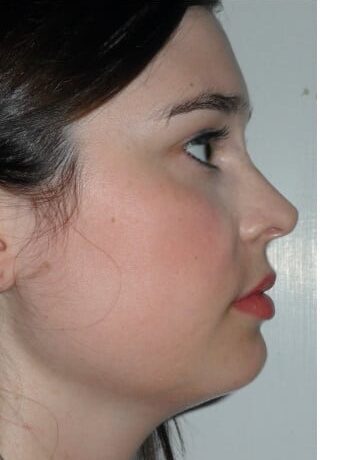 After Image: Venous Malformation - right-front-oblique