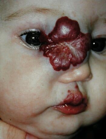 Before Image: Venous Malformation - right-front-oblique