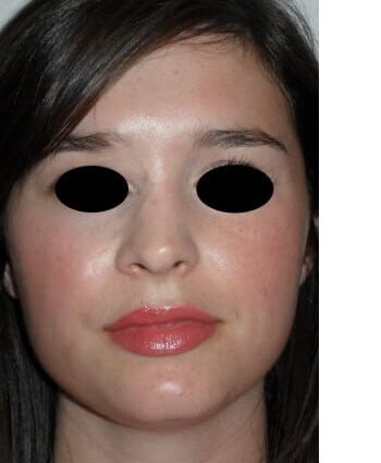 After Image: Venous Malformation - right-front-oblique