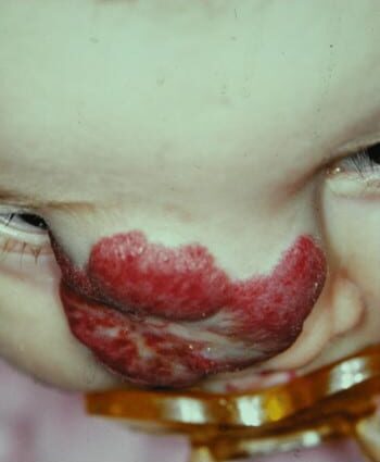 Before Image: Venous Malformation - right-front-oblique
