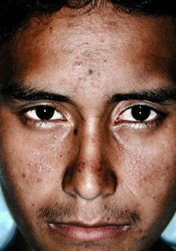 After Image: Venous Malformation - front