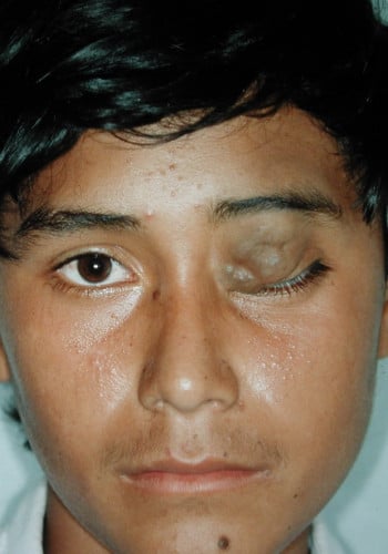 Before Image: Venous Malformation - front